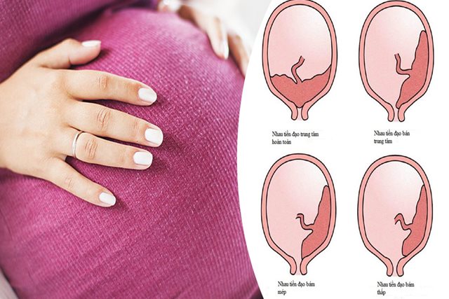 Rau tiền đạo kèm rau cài răng lược ở bà bầu nguy hiểm như nào?